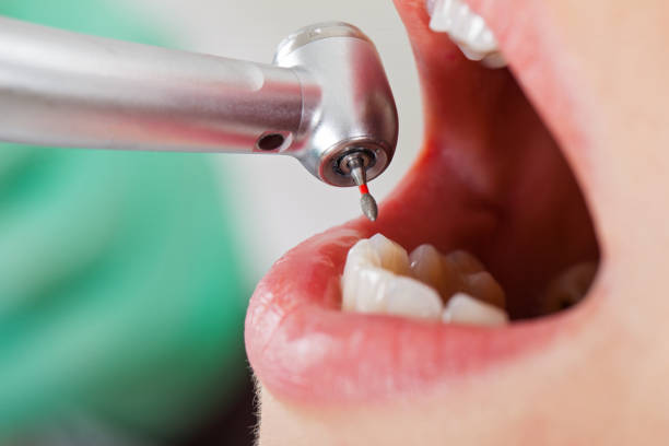 Best Emergency Dentist for Lost Fillings or Crowns in Argentine, MI